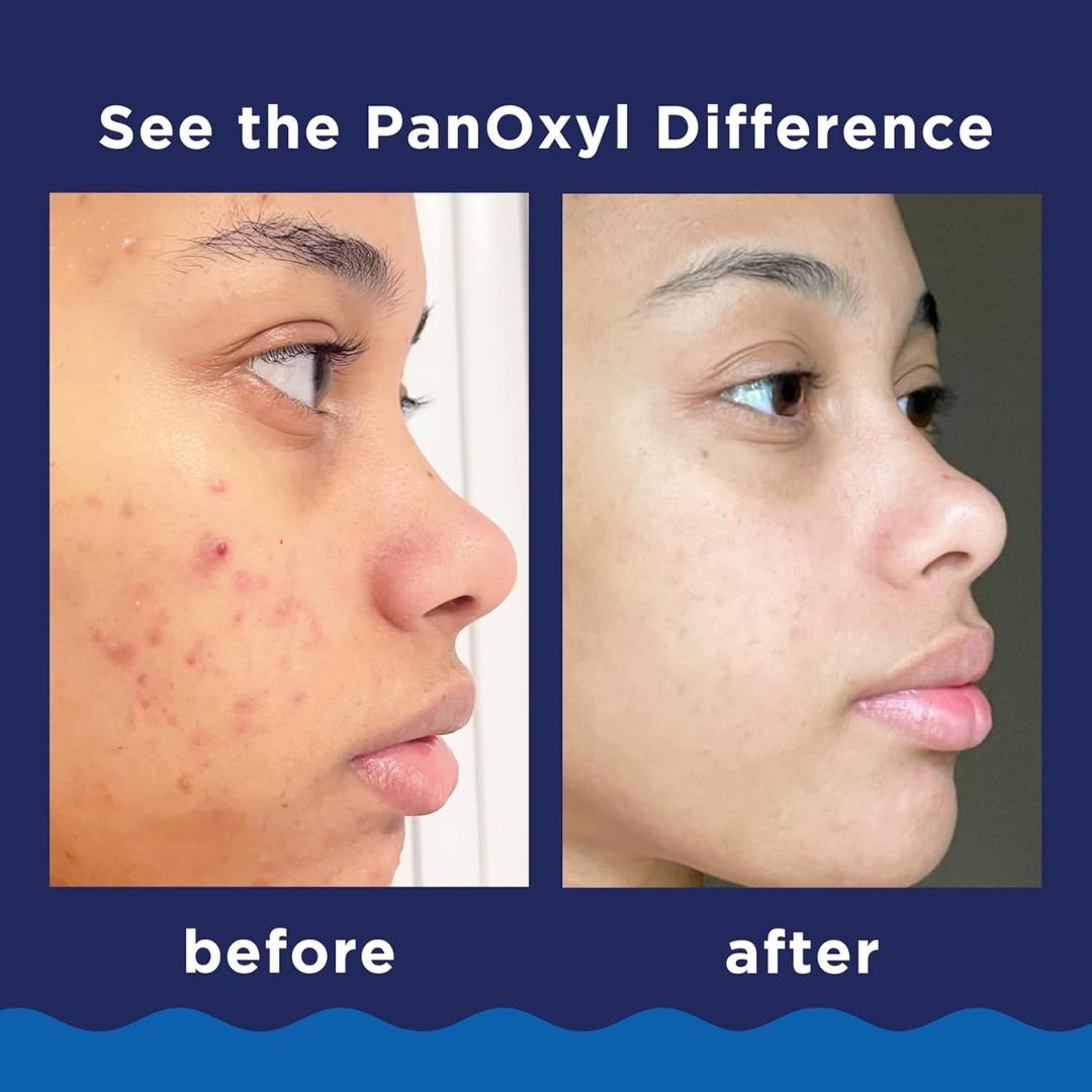 PanOxyl Acne Foaming Wash 10% Benzoyl Peroxide | Maximum Strength Antimicrobial Cleanser - Image 5